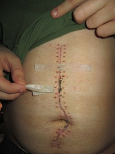 JJ's incision with staple dots and tape.